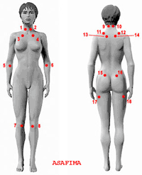 Asafima puntos de dolor de la fibromialgia